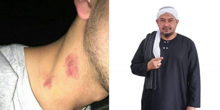 Hukum Buat Love Bite Pada Pasangan Harus, Akan Jadi Haram Bila…